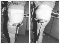 Hip Disarticulation Techniques Image