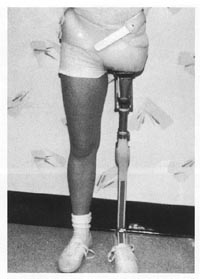 Hip Disarticulation Techniques Image